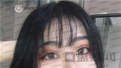 昆明悦格,陈玉琼,双眼皮,案例,价格,