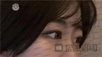 昆明悦格,陈玉琼,双眼皮,案例,价格,