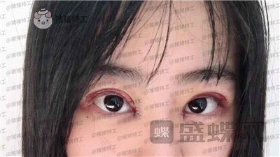昆明悦格,陈玉琼,双眼皮,案例,价格,