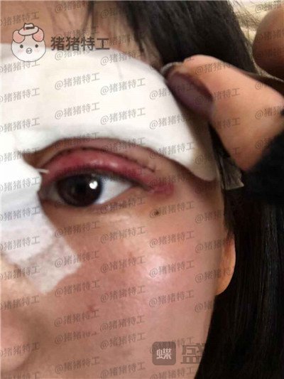 昆明悦格,陈玉琼,双眼皮,案例,价格,
