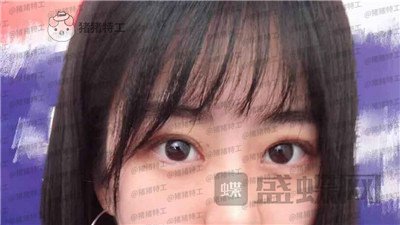 昆明悦格,陈玉琼,双眼皮,案例,价格,