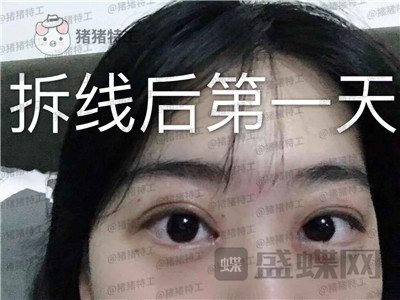 昆明悦格,陈玉琼,双眼皮,案例,价格,