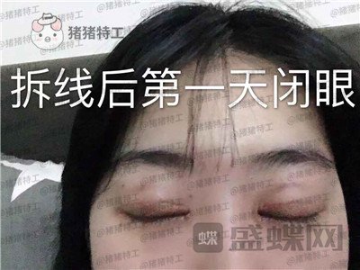 昆明悦格,陈玉琼,双眼皮,案例,价格,