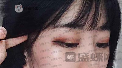 昆明悦格,陈玉琼,双眼皮,案例,价格,