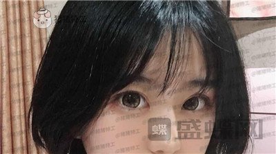 昆明悦格,陈玉琼,双眼皮,案例,价格,