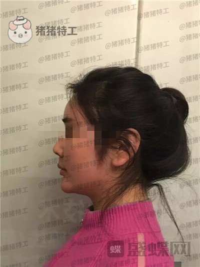 重庆姚明君,吸脂,去双下巴,案例,价格,