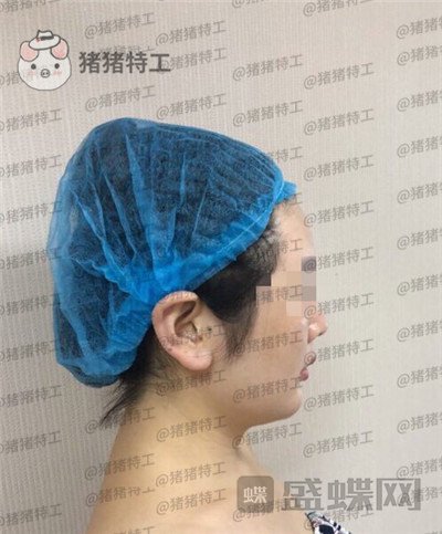 重庆姚明君,吸脂,去双下巴,案例,价格,
