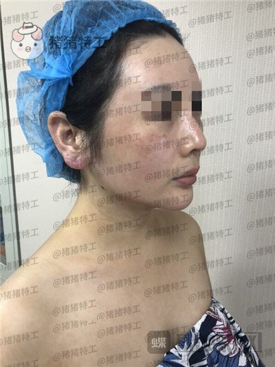 重庆姚明君,吸脂,去双下巴,案例,价格,