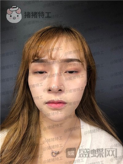 长沙艺星,陈明松,鼻修复,案例,价格,