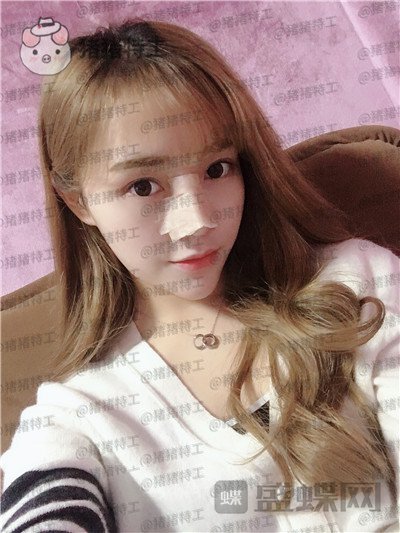 长沙艺星,陈明松,鼻修复,案例,价格,