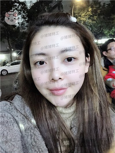 重庆华美,潘宝华,颧骨整形,案例,价格,
