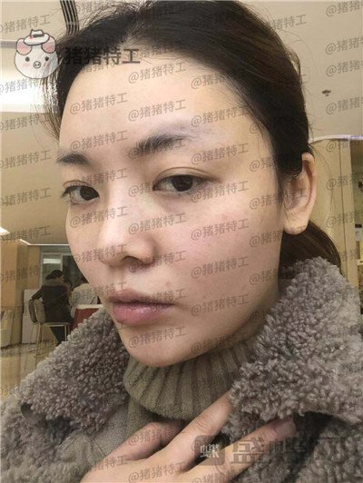 重庆华美,潘宝华,颧骨整形,案例,价格,