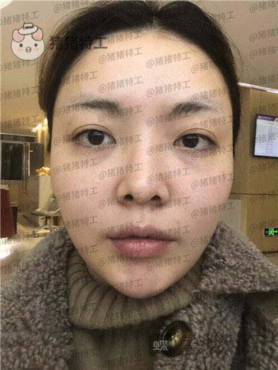 重庆华美,潘宝华,颧骨整形,案例,价格,