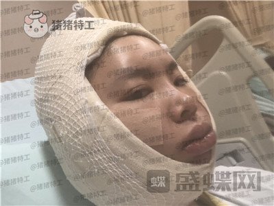 重庆华美,潘宝华,颧骨整形,案例,价格,