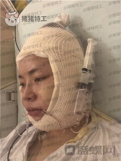 重庆华美,潘宝华,颧骨整形,案例,价格,