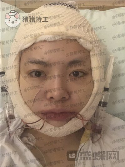 重庆华美,潘宝华,颧骨整形,案例,价格,