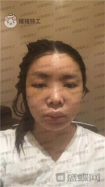 重庆华美,潘宝华,颧骨整形,案例,价格,