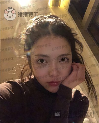 重庆华美,潘宝华,颧骨整形,案例,价格,