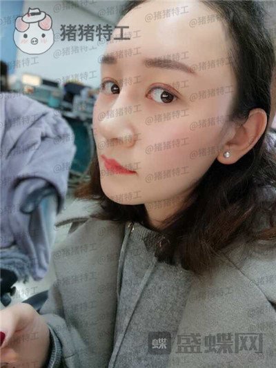 贵阳华美,黄在弘,面部填充,案例,价格,
