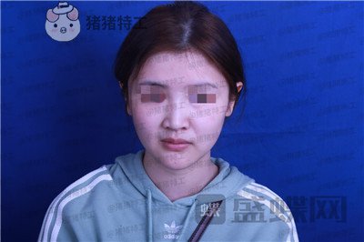 四川华人医联,张淼,鼻部手术,案例,价格,