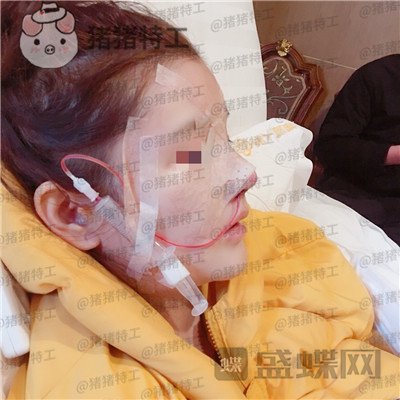 四川华人医联,张淼,鼻部手术,案例,价格,
