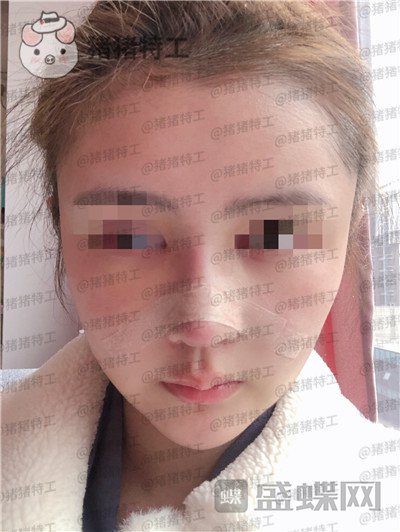 四川华人医联,张淼,鼻部手术,案例,价格,