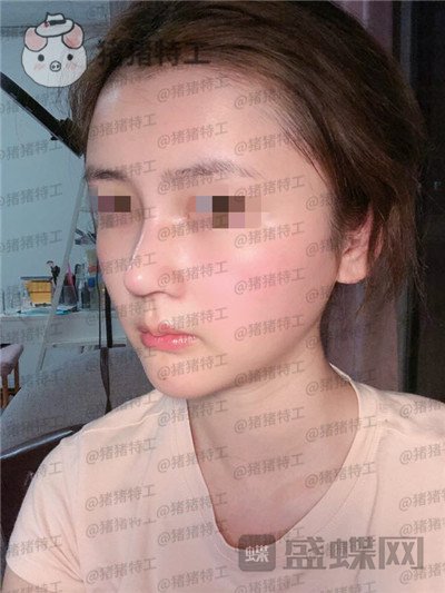 四川华人医联,张淼,鼻部手术,案例,价格,
