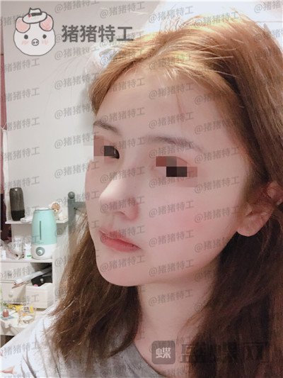 四川华人医联,张淼,鼻部手术,案例,价格,