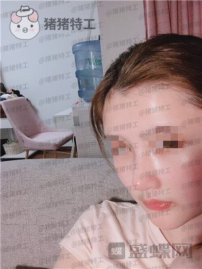 四川华人医联,张淼,鼻部手术,案例,价格,
