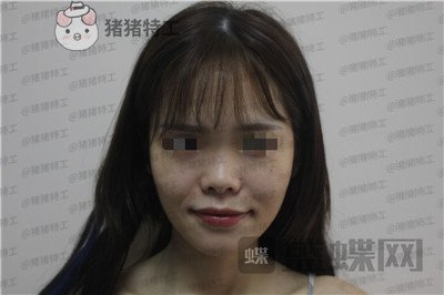 成都西区医院,车红昌,隆鼻,案例,价格,