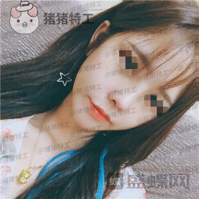 成都西区医院,车红昌,隆鼻,案例,价格,