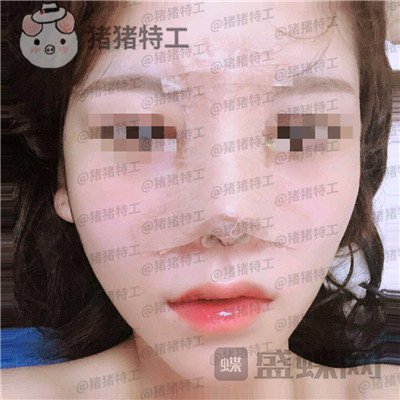 成都西区医院,车红昌,隆鼻,案例,价格,