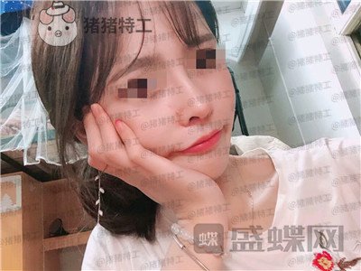 成都西区医院,车红昌,隆鼻,案例,价格,