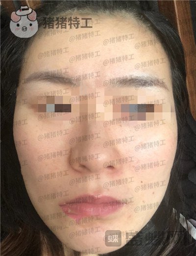 上海九院,张盈帆,下颌角整形,案例,价格,