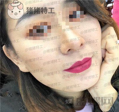 上海九院,张盈帆,下颌角整形,案例,价格,
