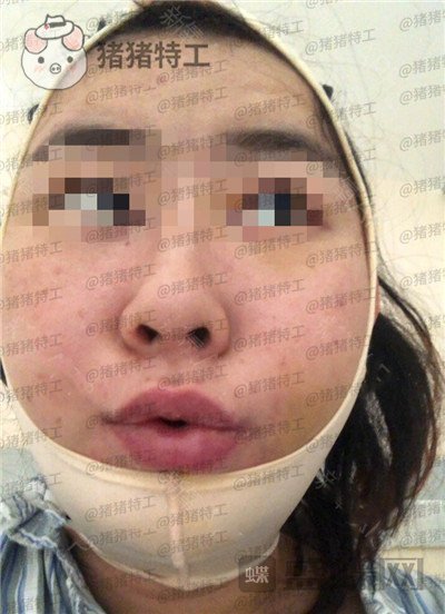 上海九院,张盈帆,下颌角整形,案例,价格,