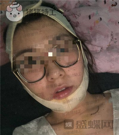 上海九院,张盈帆,下颌角整形,案例,价格,
