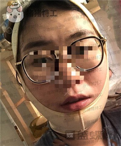 上海九院,张盈帆,下颌角整形,案例,价格,