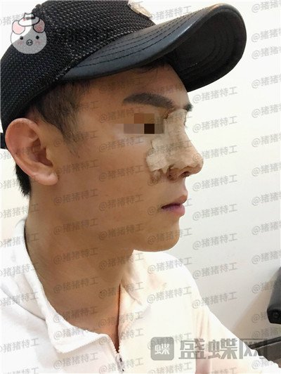 深圳艾妍,徐荣阳,隆鼻,案例,价格,