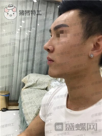 深圳艾妍,徐荣阳,隆鼻,案例,价格,
