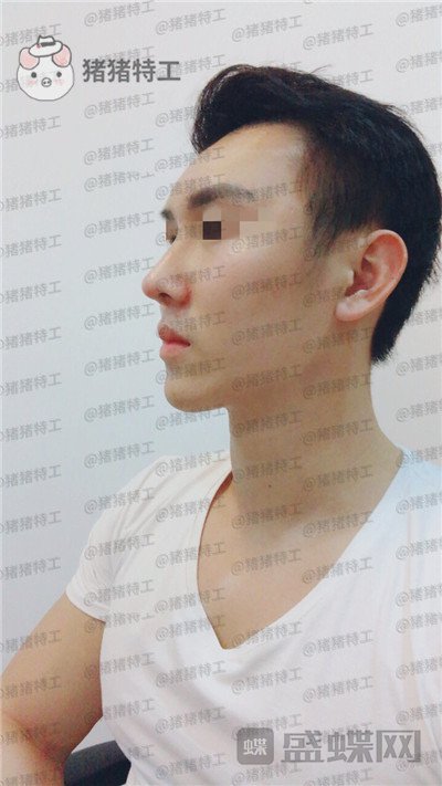 深圳艾妍,徐荣阳,隆鼻,案例,价格,
