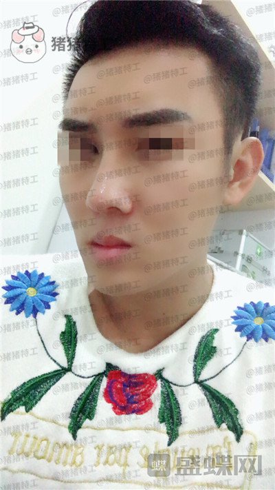 深圳艾妍,徐荣阳,隆鼻,案例,价格,