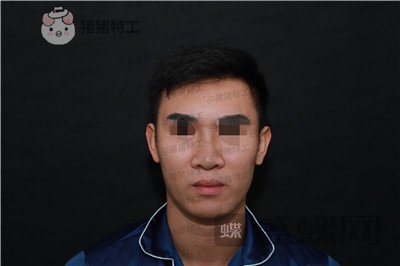 深圳艾妍,徐荣阳,隆鼻,案例,价格,