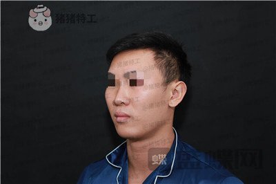 深圳艾妍,徐荣阳,隆鼻,案例,价格,