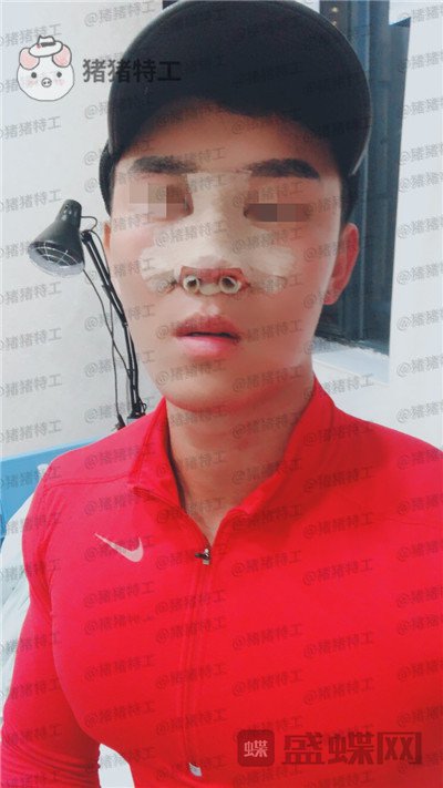 深圳艾妍,徐荣阳,隆鼻,案例,价格,
