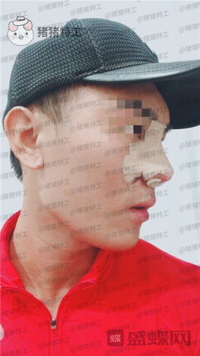 深圳艾妍,徐荣阳,隆鼻,案例,价格,