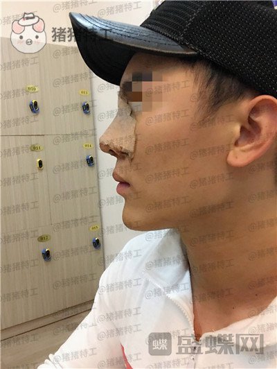 深圳艾妍,徐荣阳,隆鼻,案例,价格,