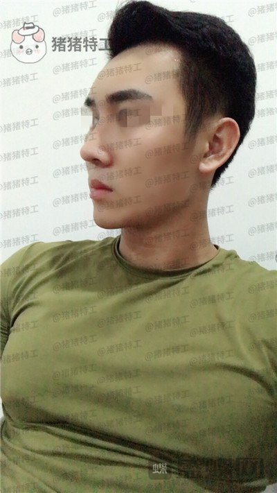 深圳艾妍,徐荣阳,隆鼻,案例,价格,