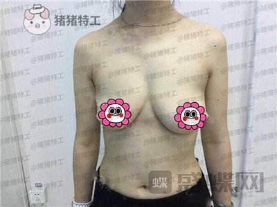 重庆五洲,魏恒,隆胸,案例,价格,