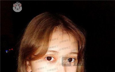 广东画美,牟北平,双眼皮,案例,价格,